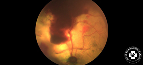 retina-levalas