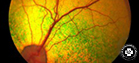 szemészeti retina degeneráció